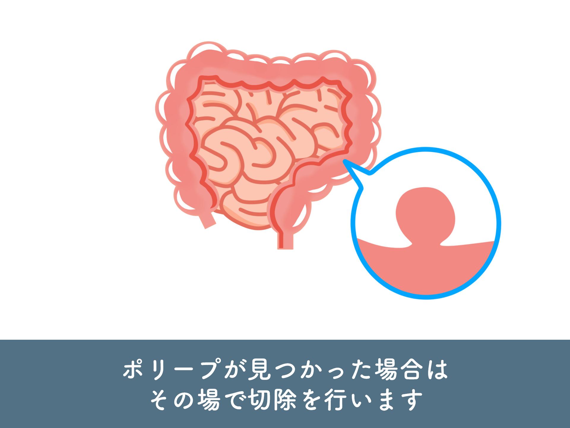 大腸カメラ検査説明